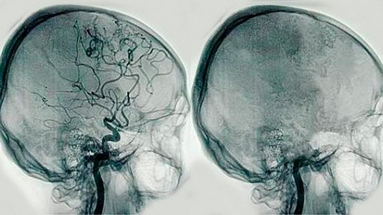 Cerebral angiography: what is it and what disorders can it detect?