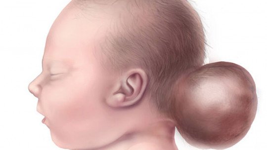 encephalocele-types-causes-symptoms-and-treatment