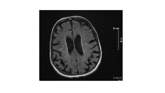 Binswanger's disease: symptoms, causes, and treatment of this dementia