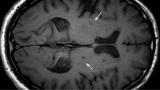 lacunar-infarction-causes-symptoms-and-treatment-virtualpsychcentre