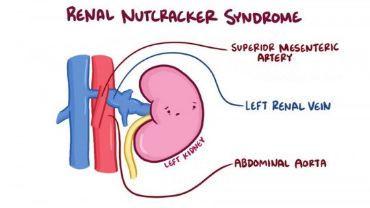 Nutcracker syndrome что это